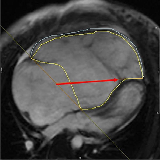 Feature Tracking Technique in Patients with Ebstein's Anomaly {faces}