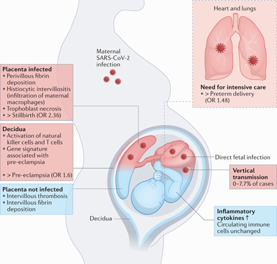 COVID-19 infection during pregnancy {faces}