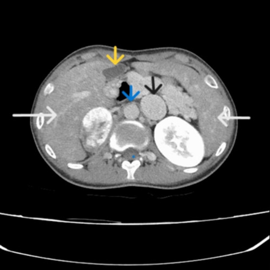 Pheochromocytoma in a patient with heterotaxy syndrome {faces}