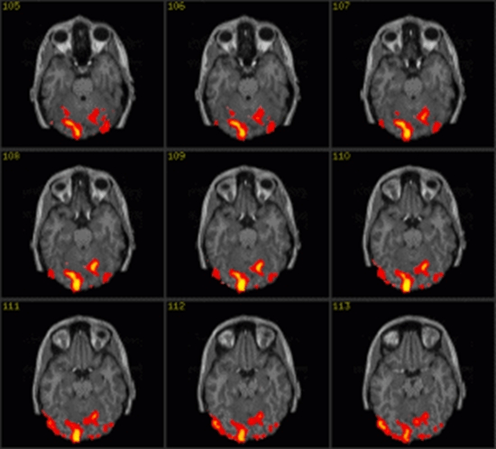 تصویربرداری پذیرفتاری مغناطیسی در نمایش ویژگی های تصویری تومورهای مغزی گلیال 