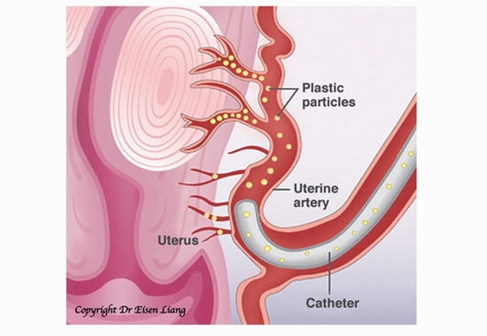 کاهش خونریزی واژینال ناشی از باقیمانده محصولات بارداری درآمبولیزاسیون شریان های رحمی با PVA 