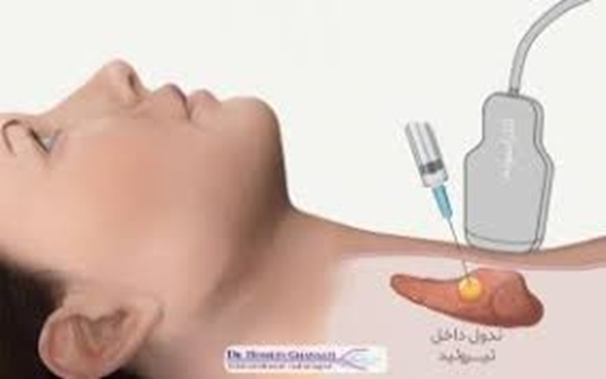 گایدلاین های2017 TIRADs و ATA 2015 در گروه بندی ندول های تیروئید 