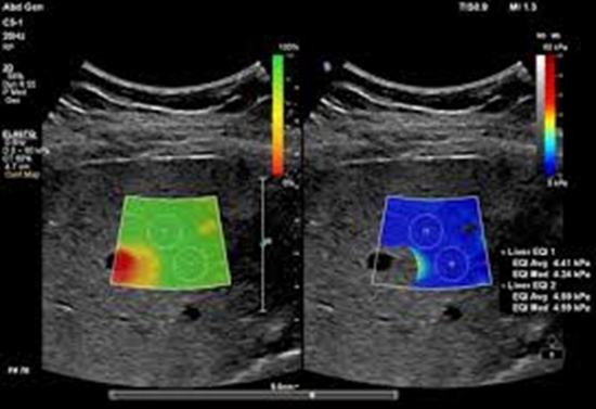 SWE ) shear wave elastography) در ارزیابی بیماران تحت پیوند کبد و ارتباط یافته های آن با عوارض کوتاه مدت بعد از پیوند کبد 