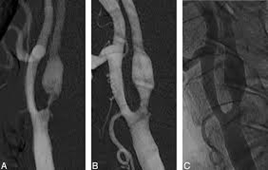 بیماران مبتلا به تنگی کاروتید درمان شده با روش استنت کاروتید 