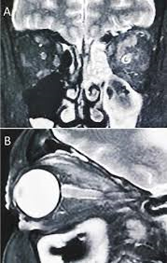 تزریق اینترا اوربیتال آمفوتریسین تحت هدایت سی تی اسکن در بیماران مبتلا به موکورمایکوزیس چشمی 