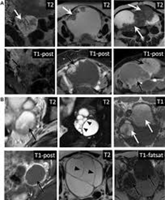 ADNEX MRI vs. O-RADS in DCE-MRI 