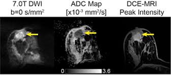 ADC در بررسی Diffusion-weighted imagining (DWI) ضایعات خوش خیم و بدخیم پستان 