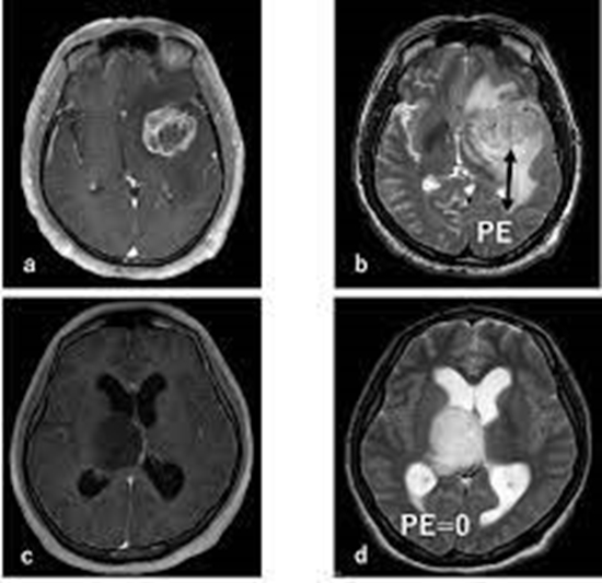  ارزش تشخیصی DWIو ADC و perfusion MRI و MRS در افتراق ادم ریکتیو از ادم اینفیلتراتیو در بیماران مبتلا به گلیومای مغزی 