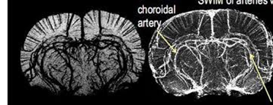 افتراق کارسینوم هپاتوسلولار از ادنوم هپاتوسلولار 