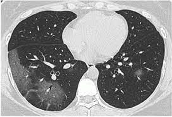 سی تی اسکن قفسه سینه مربوط به برونکوپنومونی ایجاد شده توسط کرونا 