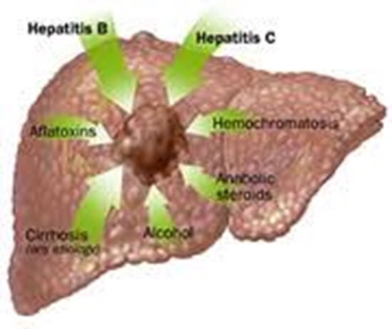 ((CT,MRI) پیش از پیوند و عود پس از پیوند در hepatocellular carcinoma 