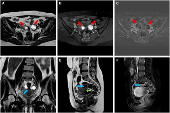 Refining MRI protocols for endometriosis {faces}