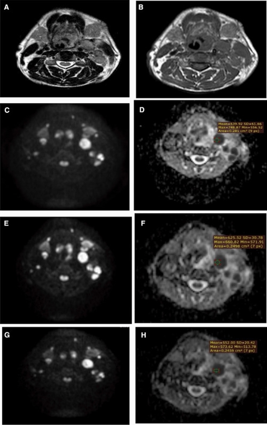 مقایسه ADC در SCC، لنفوم و بافت نرمال 