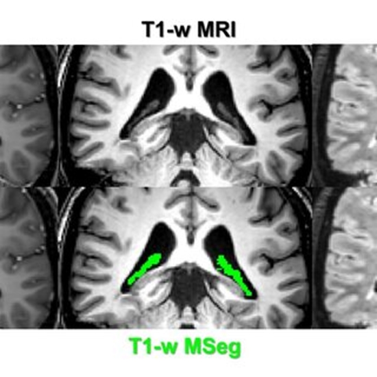 ارزیابی تغییرات تصویربرداری کوروئید پلکسوس در ام‌آر‌آی 