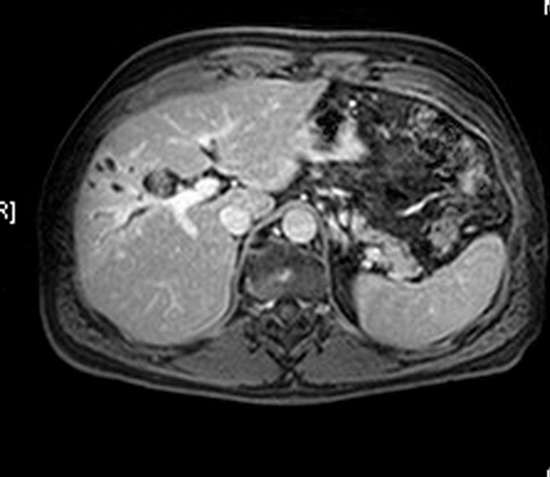 بررسی حساسیت ، اختصاصیت و دقت تشخیصی بافت سنجی کبد در ام آر آی  