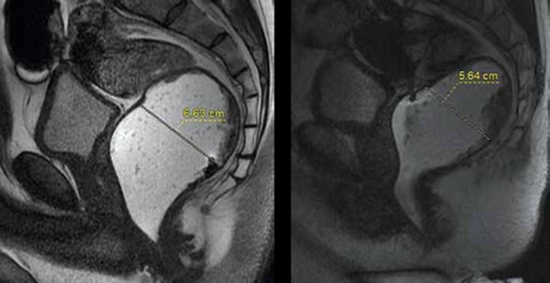 مقایسه بیوفیدبک و درمان استاندارد در سندرم انسدادی دفع 