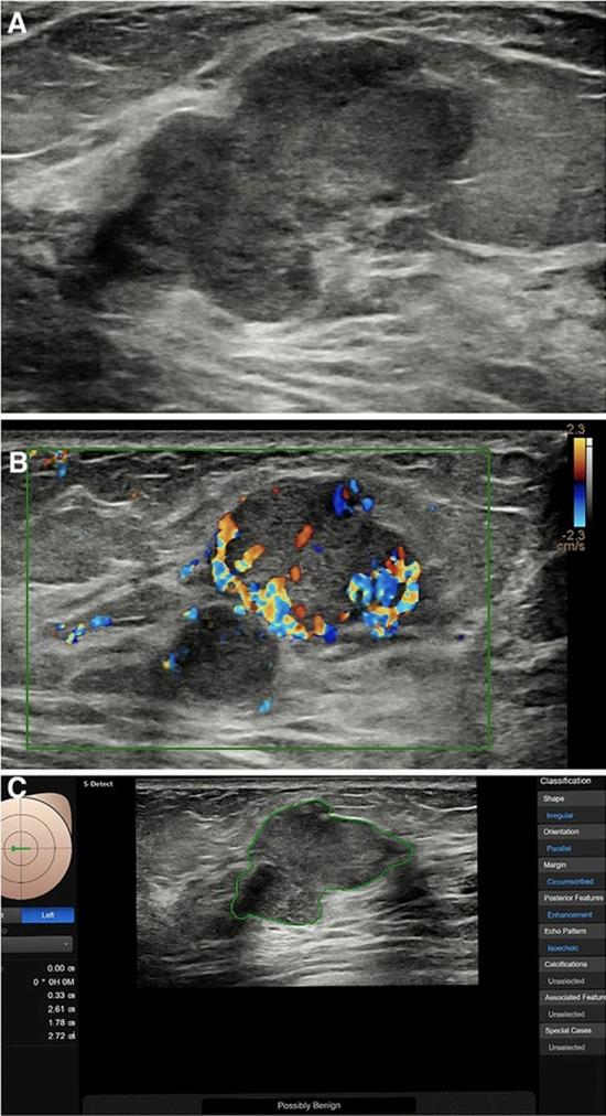 بررسی میزان ارزش اخباری مثبت برای سرطان پستان درضایعات بایردز 4a 