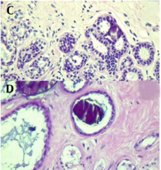 Stereotactic-Guided Vacuum Biopsy in Breast Microcalcifications {faces}