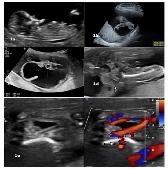 Ultrasonography and mri in a Fetus with Sacrococcygeal Teratoma {faces}