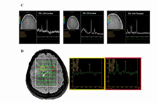 MR Spectroscopy of Intracranial Chondroma and Chondrosarcoma  {faces}