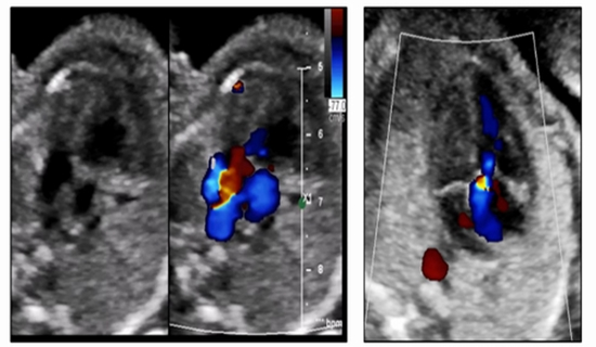  fetal cardiac anomalies and their outcomes in isolated cardiac anomalies and non-isolated groups and based on minor and major a {faces}