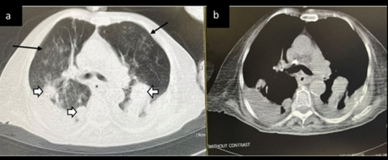  chest CT scan in preexisting cancer and COVID-19  {faces}