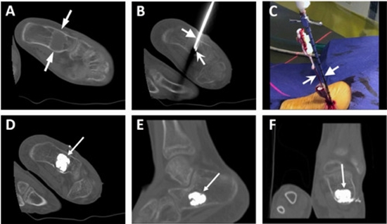 CT-Guided Double-Needle Cement Injection for Calcaneal Bone Cyst {faces}