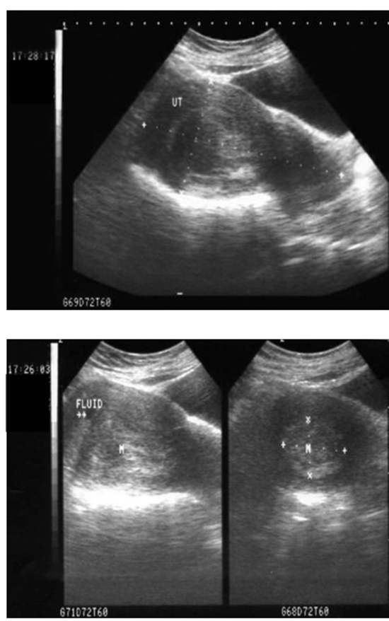  uterine artery embolization {faces}