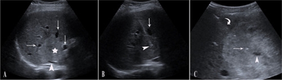  percutaneous sclerotherapy with bleomycin for giant hepatic venous malformation {faces}