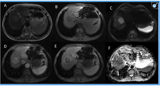 Assessment of LI-RADS efficacy in classification of hepatocellular carcinoma {faces}