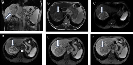Apparent Diffusion Coefficient MRI in Hepatocellular Adenoma {faces}