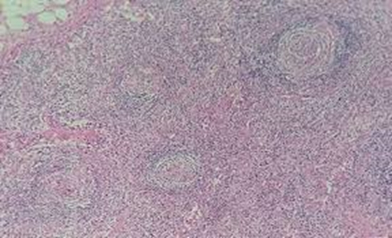  Huge splenomegaly in an HIV-infected patient {faces}