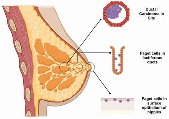 Mammary Paget’s Disease Mimicking Benign and Malignant Dermatological Conditions {faces}