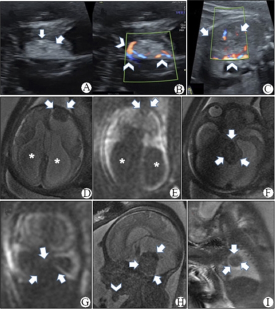 Congenital Disseminated Pyogenic Granuloma {faces}