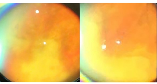 Varicella Zoster Virus-induced Acute Retinal Necrosis  {faces}