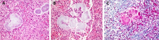 Primary Actinomyces in Hand {faces}