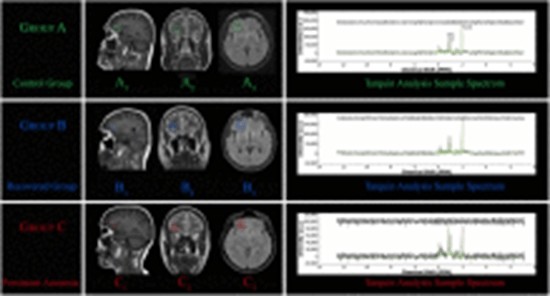 Neurochemical Alterations Linked to Persistent COVID-19-Induced Anosmia {faces}