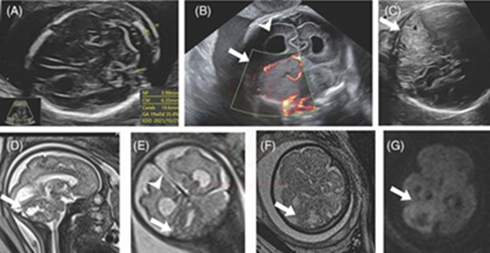 Prenatally detected congenital medulloblastoma {faces}