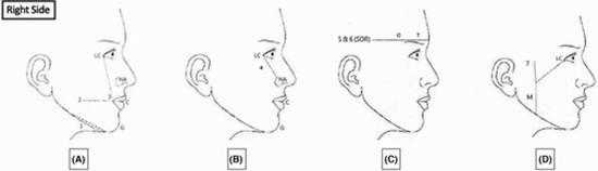 Anatomic evaluation of the normal variants of the arteries of face using color Doppler ultrasonography {faces}