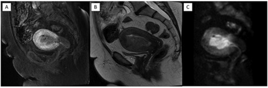Diagnostic value of T2 and diffusion-weighted imaging (DWI) in local staging of endometrial cancer {faces}