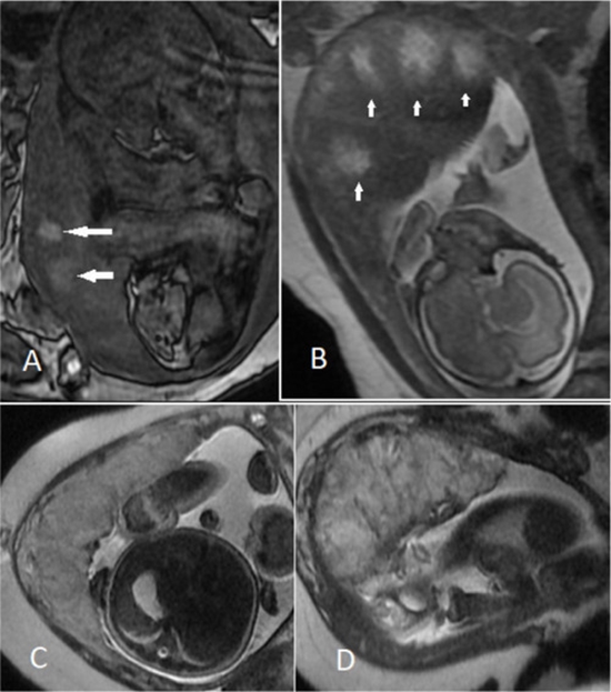 MRI-Based Models for Detecting IUGR & Placental Insufficiency {faces}
