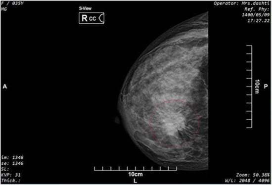 Synthesized vs. Digital Mammography in Screening {faces}