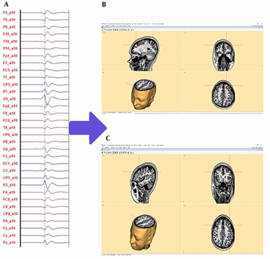 Non-invasive EEG Imaging for Pediatric Epilepsy Localization {faces}