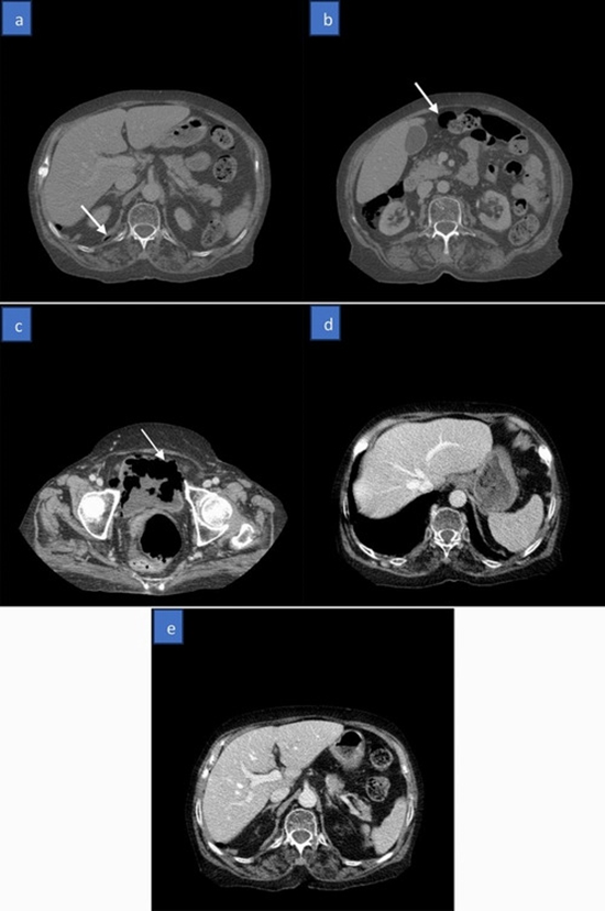 hepatic portal venous gas (HPVG) diagnosed as emphysematous cystitis {faces}