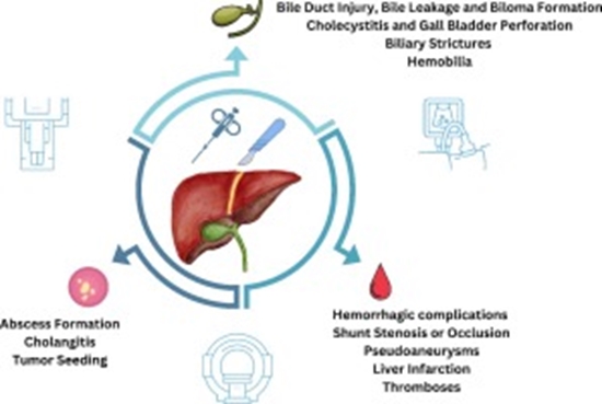 An exploration of radiological signs in post-intervention liver complications {faces}