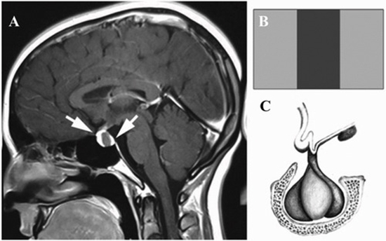 Vertical triband flag sign for differential diagnosis of Rathke's cleft cyst {faces}