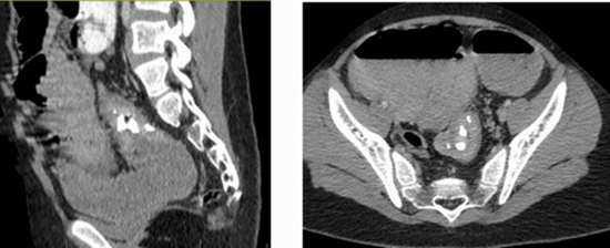 Pediatric Inflammatory Myofibroblastic Tumor of Rectosigmoid Junction {faces}