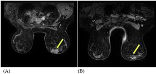 (DCE-MRI) in the prediction of neoadjuvant chemotherapy response in breast cancer {faces}