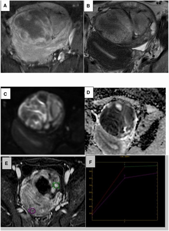 Modified MR scoring for indeterminate ovarian/adnexal masses without contrast {faces}