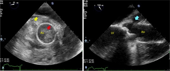 Fungal endocarditis in aortic valve replacement {faces}